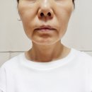 밝은마음병원 | 팔자주름 수술 후기 1년차 (병원 선택)