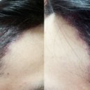 한채영헤어라인 | 헤어라인교정 / 헤어라인 모발이식 후기 - 수술 당일