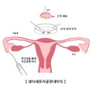 생식세포자궁관내이식 Gamete intrafallopian transfer 이미지