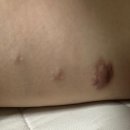 (주)우성양행 | 다발성 피지낭종 치료후기
