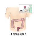 대장암(Colon cancer) 이미지