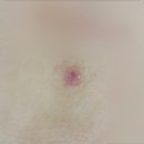 별이성형외과의원 | 강남 맑고고운라벨라의원 살툭튀 재발점 제거후기 2탄 - 경과, 케어방법, 실밥사진