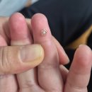 기쁜샘약국 | 사마귀, 냉동치료 말고 베루말액