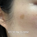 얼굴 흑자 검버섯 기미 차이 없애는법부터 제거크림추천템 후기까지