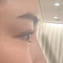 위례 피부과 포에버의원 바로 일상생활가능한 간편한 하이코 시술후기