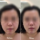 오산피부관리｜웨딩관리 필수코스 &#39;아네스뷰티&#39; 윤곽관리 솔직후기