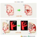 뇌혈관질환(Ⅰ) 분류표와 뇌혈관질환(Ⅱ) 분류표의 비교 이미지