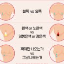 유방 상피내암, 제자리암 증상 및 수술 치료 (초기 유방암 0기, 유두 습진, 분비물) 이미지
