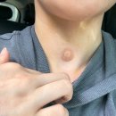 선진맑은샘내과의원 | 갑상선수술 비전형세포3단계입원준비물 수술후기 부산좋은문화병원 (1)