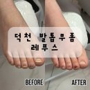 꼬지와친구들 덕천점 | 부산 발톱 무좀 스케일링 레푸스덕천점 후기