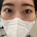 은하수안과의원 | 속다래끼 안과에서 짼 후기