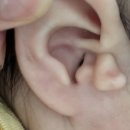 후 선천이상수술비 보장보험처리 코드 후기공유 (신생아스킨택, 선천성부이주, 아기귀젖, skin tag...