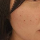 제니바의원 | 건대 피부과 제니바의원 모공주사 내돈내산 솔직후기