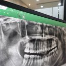 양치과의원 | 입술 찢어짐 앞니 부러짐 임플란트 인천 바른플란트치과의원 후기 #2