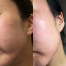 라비앙사우나 | 신부관리 강남 기미 잡티제거 성지 힐비뇨기과 다녀옴 솔직후기 사진있음
