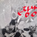 테크노성모외과의원 | 담낭절제수술 담낭선근종증 단일공 복강경 : 인천 부평 성모k외과의원 절제술 비용 후기