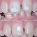 서울 신사역 [레브치과] 20명이 동시에 치아미백을 할 수 있는 치과가 여기있습니다.