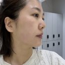 모던성형외과의원 | 아몬드성형외과논현점 심승현원장님 울쎄라피프라임...심부볼 리프팅 이중턱 시술(후기 통증 가격 효과)