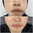 아롱이의 방이동피부과 살롱드비숑 잠실점 mts 탄력관리 후기