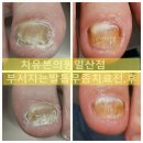 벧엘동물병원 | 일산 [파주][삼송]직업군인 부부의 발톱무좀 치료 후기, 아이까지 전염될까 두려웠어요…메디컬의원 일산