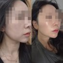 타겟링크 | 압구정피부과에서 받은 볼링크4D의 후기 (소요시간,통증,후관리)