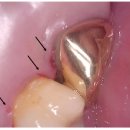 서울닥터한치과의원 | 스케일링 잇몸치료 차이, 후기 통증, 고통 정도는? 무서워요..
