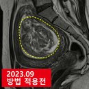 자궁근종 원인과 증상 (6개월 자연치유 후기)