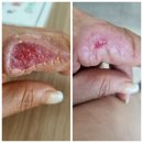 (주)에이스원글로벌 | 빙초산 피부녹이는 독성물질 빙초산피해
