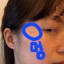 플레니어피부과 | [피부과 추천] 수원 화성 목동 | 플레니어 피부과 | 인모드 후기 (1회차)