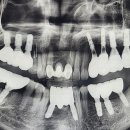 함께하는치과의원 | 임플란트 재식립까지… 제 얘기입니다 군산 함께하는치과에서 다시 웃게 된 후기