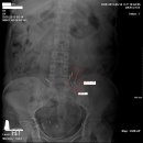 방광근처 요관결석을 내시경 수술후 내원한 61세 여자환자 이미지