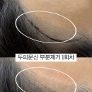 유화헤어라인