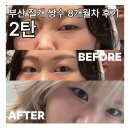 하얀멍이 | [부산 서면] 무쌍 절개 눈매교정 8개월차 내돈내산 후기 낋여옴 [2편]
