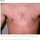 Ringworm ( tinea,백선증 ) ( cat, dog, 사람 - 인수공통감염 ) 이미지