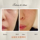 위드유토탈케어 | [동탄피부샵] 유뷰티 토탈케어에서 플라즈마 피부관리 후기