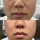 봉곡로23길-10 | 구미 봉곡 "글로우핀" 마이크로젯 레이저로 예비신랑 팔자주름 관리