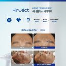 주식회사 엘피지오 본사 | 에어젝트 임상 후기 사진입니다!