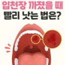 입천장 부음 통증 아픔 구멍 물집 화상 대처법 이미지