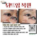 뒤트임 부작용 및 뒤트임 복원 후기,비아이오성형외과 홍성표원장