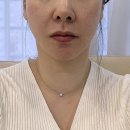 서울엘피부과의원 | 서울 강남역 피부과 얼굴주름리프팅 덴서티 효과 리쥬란 힐러 가격 후기