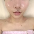 스킨피아 | 종로 광화문 얼굴리프팅 에스테틱 스킨피아 JH 윤곽술 리얼 후기