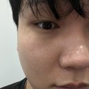 성샤인 | 강남역 피부과 여드름 흉터 치료 후기｜라비앙 레이저 + 샤인필 1주일 변화