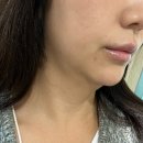 에이포의원 | 압구정온다리프팅 에이포의원 내돈내산 후기