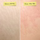 위례메디칼약국 | 분당 튼살커버 주블링&amp;스킨52 메디컬타투 1회차 리얼 후기