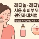 테라로직(주) | 레티놀·레티날 사용 후 피부 뒤밀림 원인과 대처법 | 안전한 레티노이드 적응기 가이드