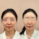 선996 | 수원 영통 선에스테스파 | 숨은턱선찾기 퍼스널 윤곽케어 내돈내산 후기
