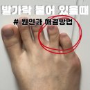 닥터발가락 | 무지외반증, 발가락끼리 붙을때 원인과 치료 방법(+교정기 추천)