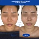 쥬니 | 부천 극초단파 관리 티리온엑스 후기, 옥길동 쥬니에스테틱 이중턱 탄력 변화 과정