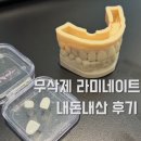 라미네 | 무삭제 라미네이트 내돈내산 후기 (오픈바이트 개방교합)