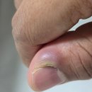 엄지 손가락 고름차서 병원에서 뺀 후기